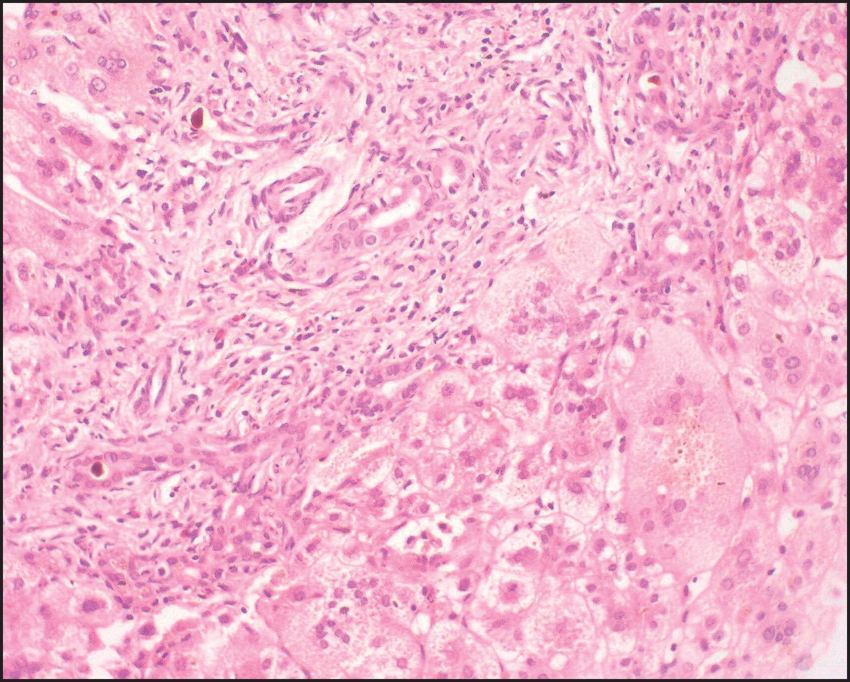 Figure 3.11, Biliary atresia. Portal features of distal obstructive cholangiopathy are associated with giant cell transformation in the parenchyma. (H&E stain.)