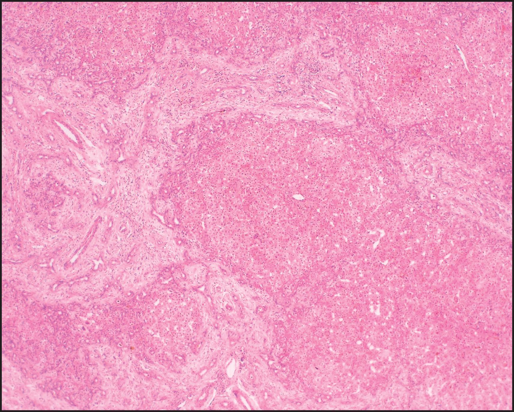 Figure 3.12, Biliary atresia, cirrhotic transformation. Portoportal bridging septa made of oedematous fibrous tissue show a marginal ductular reaction and delineate small, irregularly shaped parenchymal nodules. (H&E stain.)