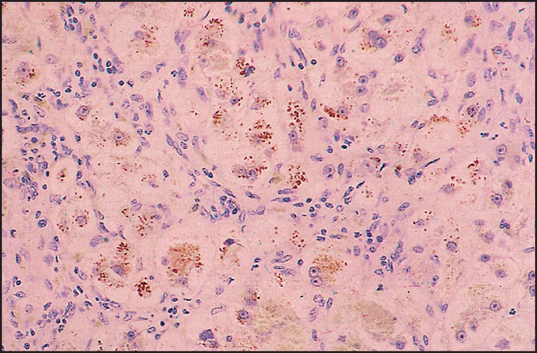 Figure 3.14, Biliary atresia. Same case as illustrated in Figs 3.12 and 3.13 . Marked copper accumulation in liver cells (red granules) . (Rhodanine stain.)