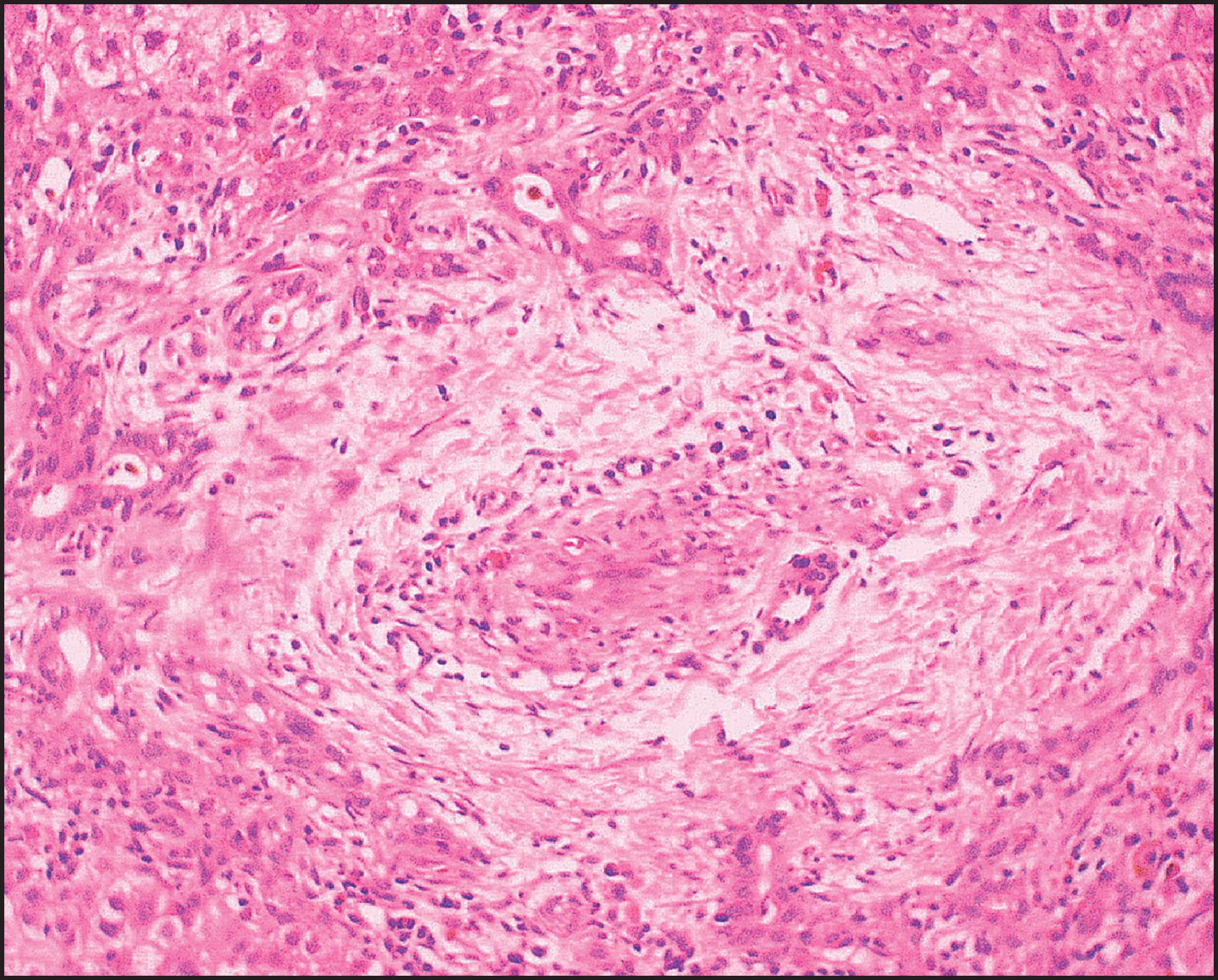 Figure 3.15, Biliary atresia. Inflamed and arteriole-rich, lemon-shaped fibrous tissue marks the site of a small, largely destroyed, intrahepatic bile duct. (H&E stain.)