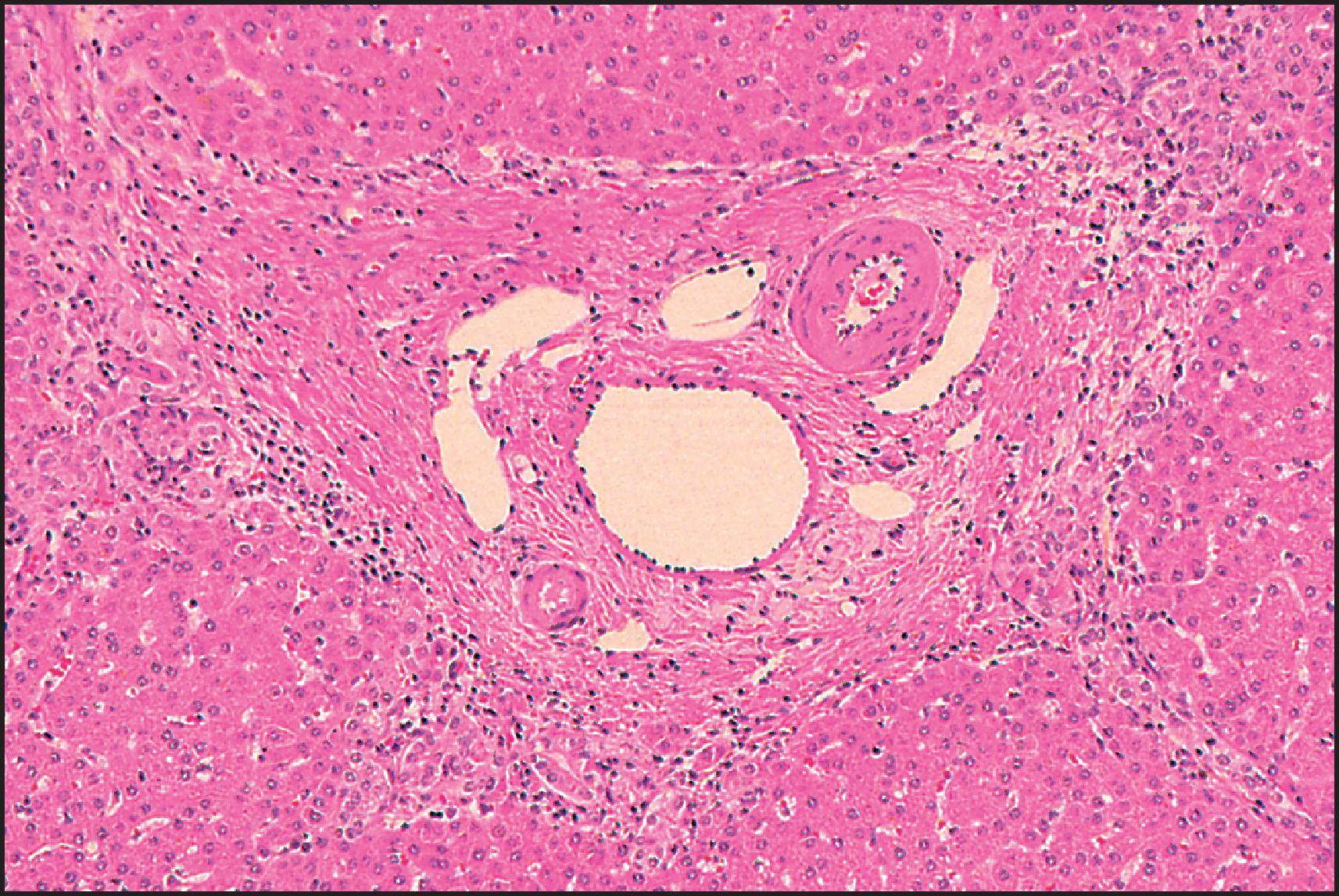 Figure 3.16, Biliary atresia. A portal area is bereft of bile ducts. There is periportal cholangiolar reaction with an associated neutrophilic response. (H&E stain.)