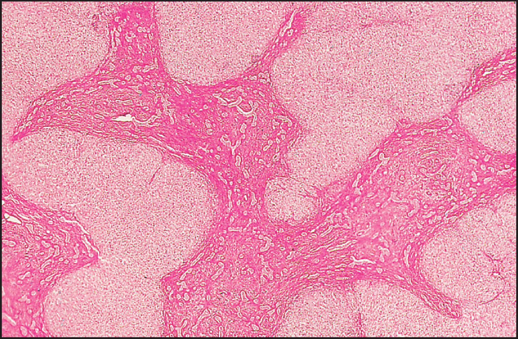 Figure 3.17, Biliary atresia. Liver resection 1 year after portoenterostomy. Pattern of fibrosis and reactive small bile ducts and ductules are reminiscent of congenital hepatic fibrosis. There were only minimal chronic cholestatic features in this liver. (Periodic acid-Schiff [PAS] stain after diastase digestion.)