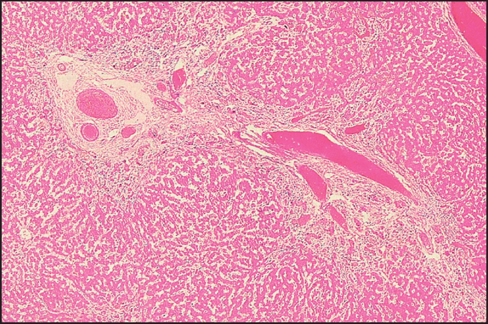 Figure 3.19, Arteriohepatic dysplasia (Alagille syndrome). Two fused portal areas lack bile ducts. (H&E stain.)