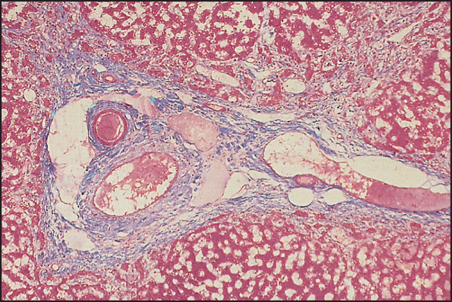 Figure 3.20, The same case as illustrated in Fig. 3.19 . Portal area contains vessels but no ducts. There is patchy periportal fibrosis but no cholangiolar proliferation. (Masson trichrome stain.)