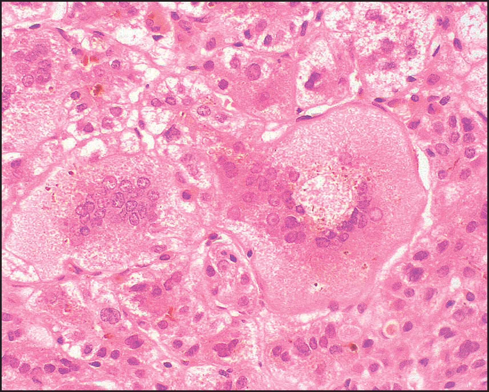 Figure 3.2, The same case as illustrated in Fig. 3.1 . Detail of multinucleated giant hepatocyte. Periphery of cell (left) suggests fusion with several smaller cells. (H&E stain.)