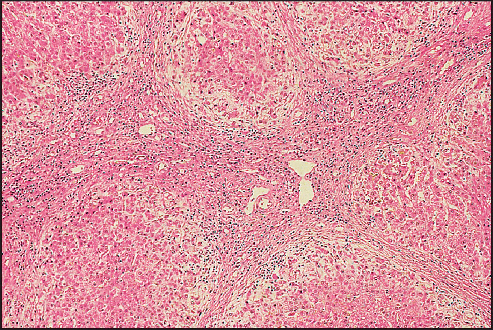 Figure 3.21, Arteriohepatic dysplasia. Micronodular cirrhosis. Note ductopenia, moderate septal inflammation and cholate stasis. (H&E stain.)