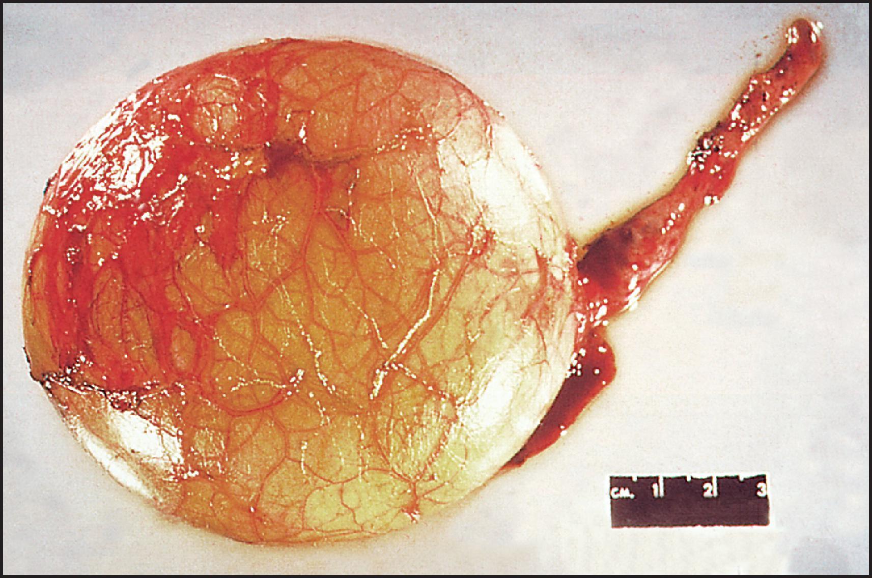 Figure 3.22, Choledochal cyst measuring about 10 cm in diameter. Note numerous vessels over the surface.
