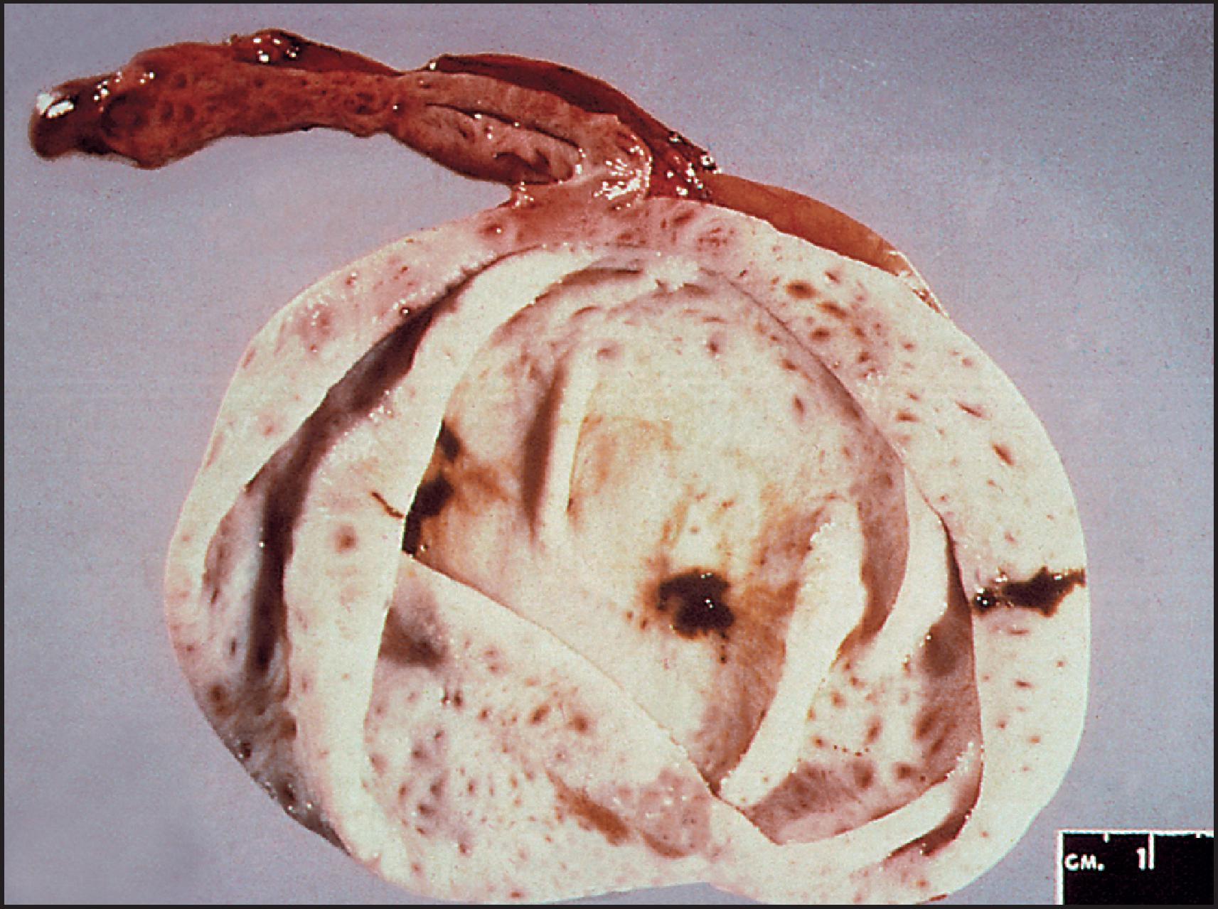 Figure 3.23, Same cyst as illustrated in Fig. 3.22 . Opened, collapsed cyst has a smooth inner lining. It did not contain bile.