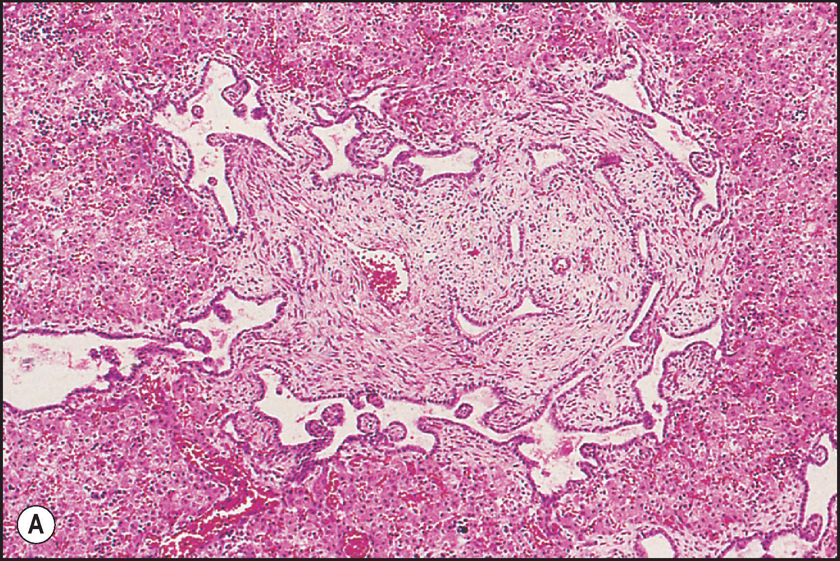 Figure 3.26, Autosomal recessive polycystic kidney disease. (A) The bile ducts form an interrupted ring at the periphery of what should eventually become a portal area. There is no interlobular bile duct. Note branch of portal vein, as well as smaller vessels. (B) The same case, with higher magnification of part of the ductal plate showing irregularity in outline of the ducts with polypoid projections into a dilated lumen. The lining epithelium is low cuboidal. (A and B, H&E stain.)