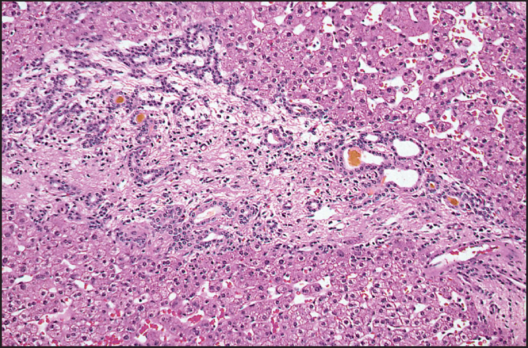 Figure 3.28, Congenital hepatic fibrosis. Fibrous tissue contains small bile ducts, a few of which are dilated and contain bile. Note the absence of inflammation. The adjacent hepatic parenchyma shows no evidence of cholestasis, and the patient is jaundice free. (H&E stain.)