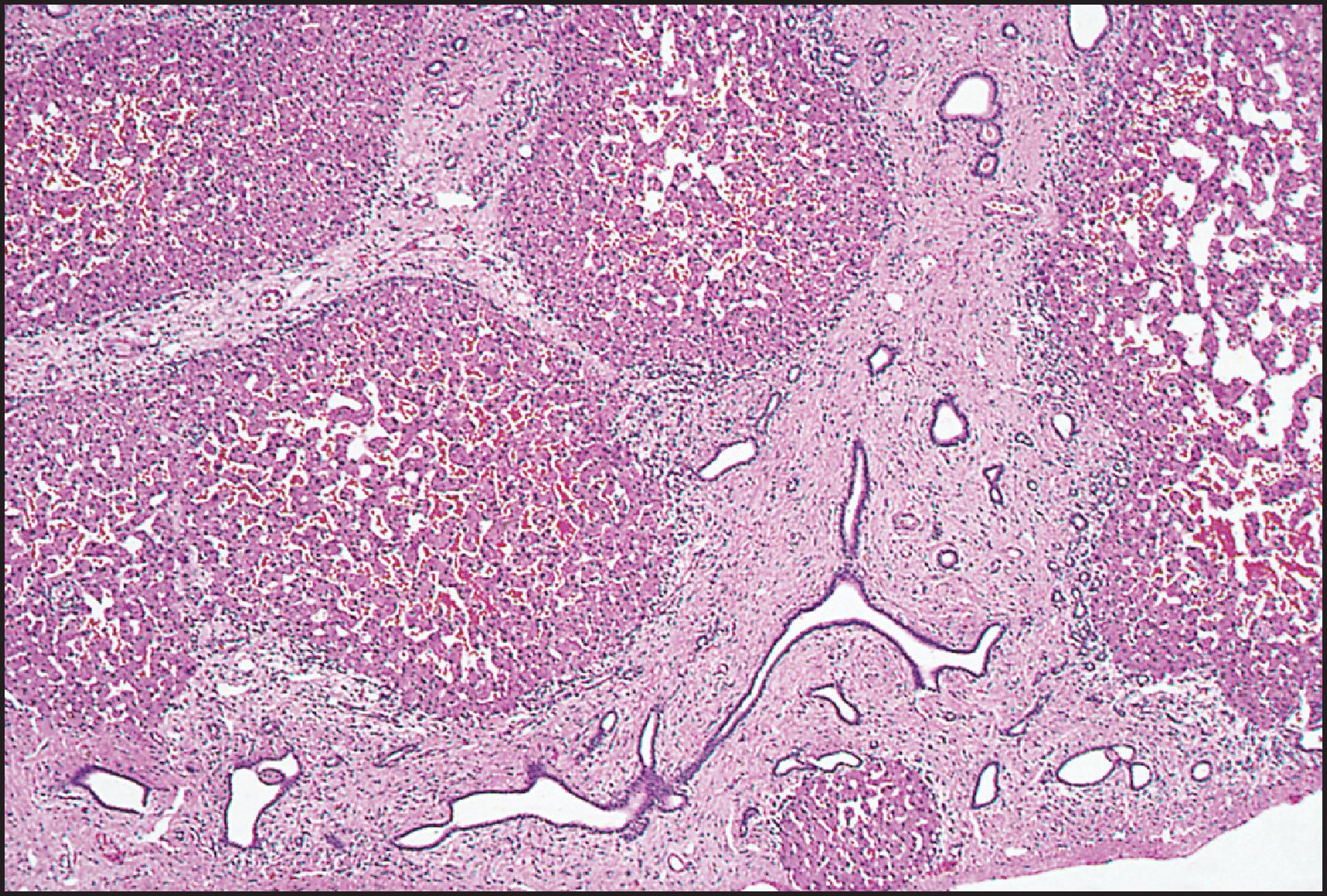 Figure 3.29, Congenital hepatic fibrosis. The same case as illustrated in Fig. 3.28 . The appearance of ducts suggests part of a ductal plate malformation. (H&E stain.)