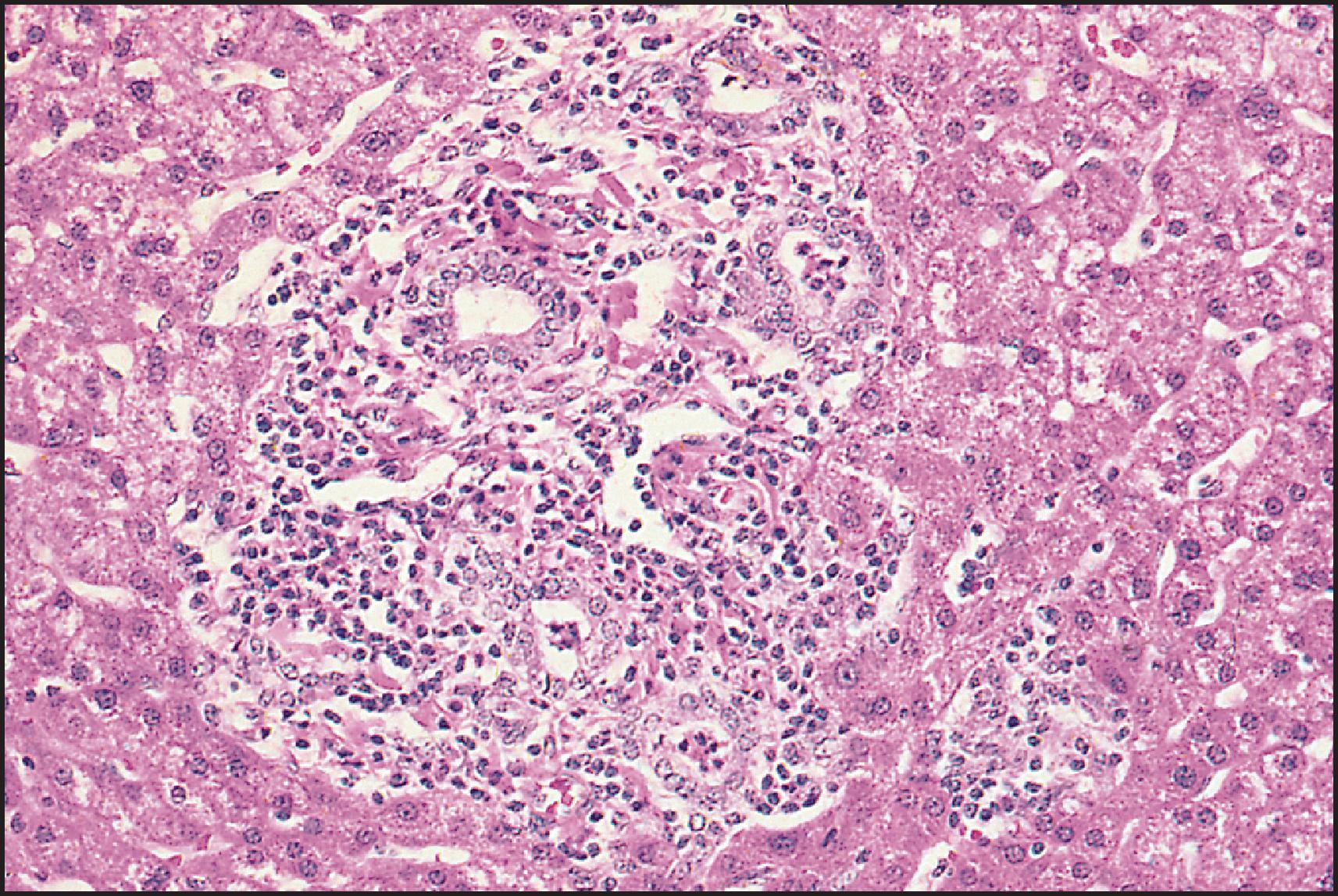 Figure 3.30, Congenital hepatic fibrosis, ‘cholangitic type’. The ducts are involved by an acute cholangitis. (H&E stain.)