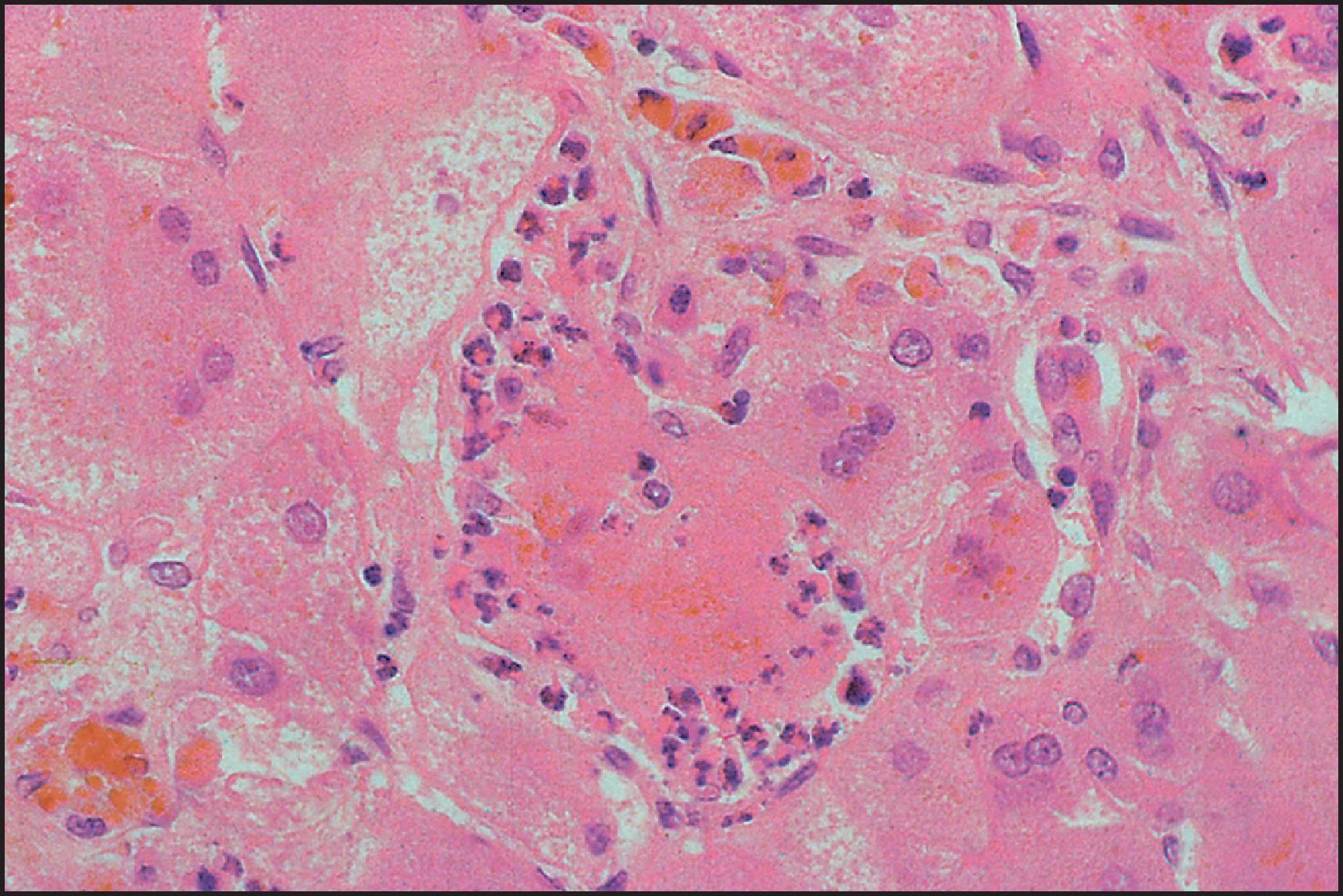 Figure 3.3, The same case as illustrated in Figs 3.1 and 3.2 . Neutrophilic satellitosis of degenerated giant cell. (H&E stain.)