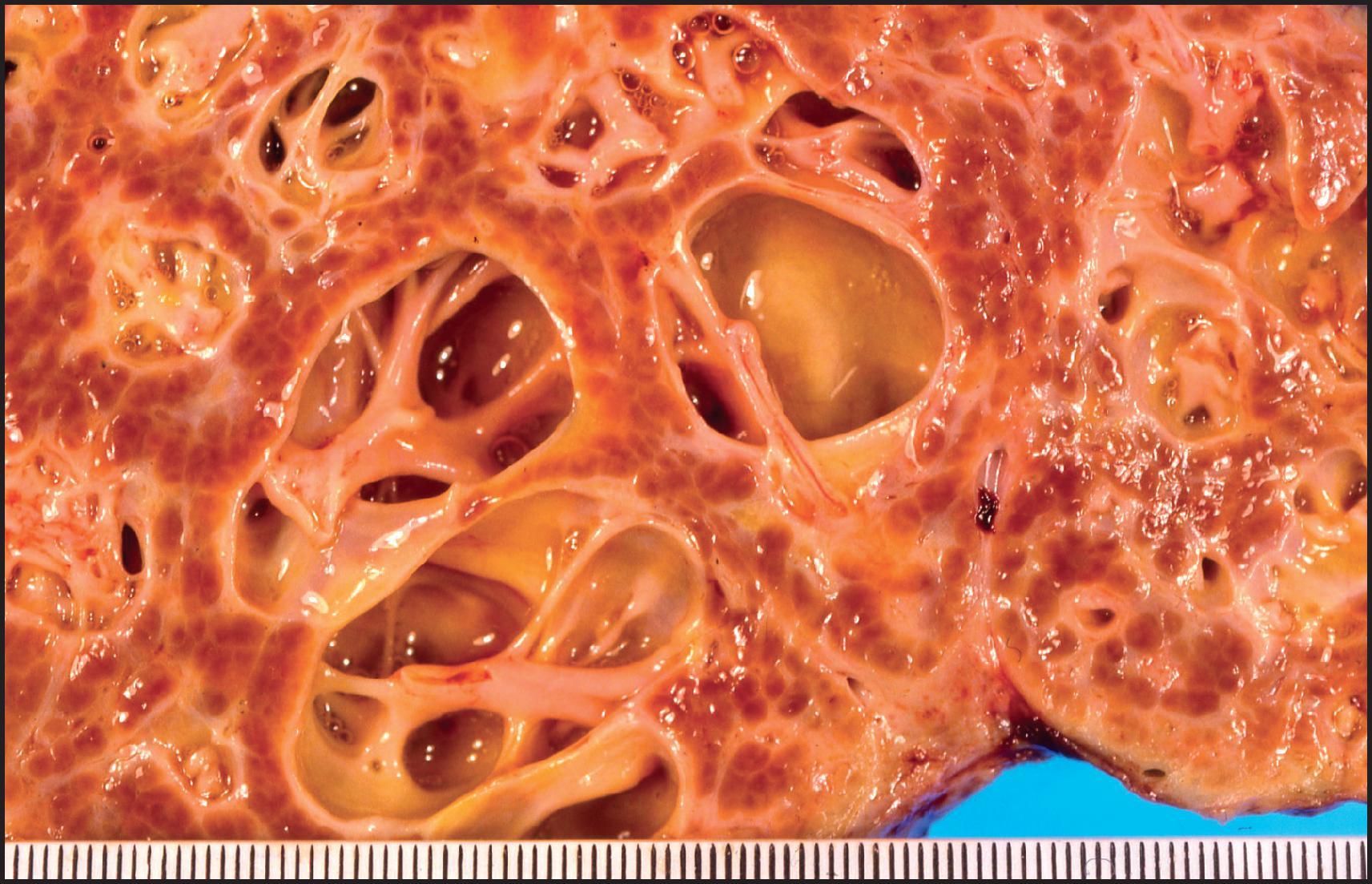 Figure 3.31, Caroli disease. Section of the liver shows cystically dilated bile ducts. The cystic cavities are traversed by fibrous cords, known to contain the portal vessels. The lining of the ducts is bile stained.