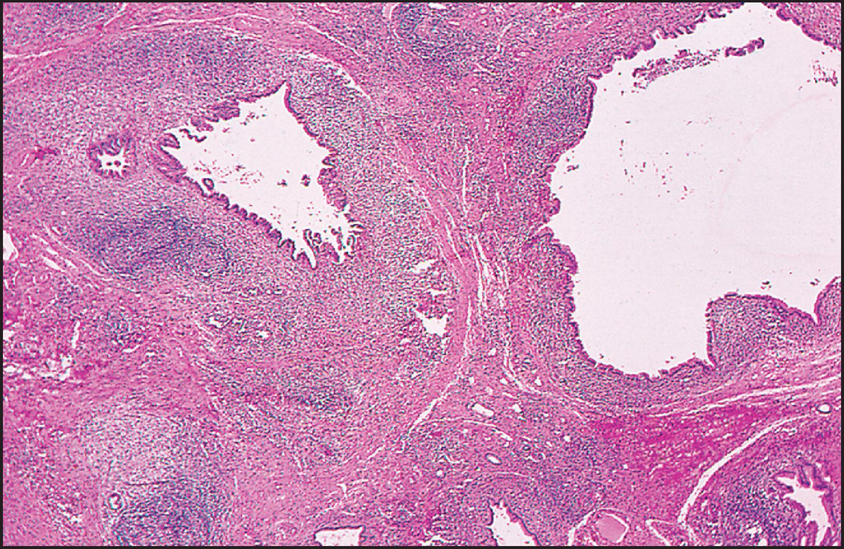 Figure 3.32, Caroli disease. Dilated bile ducts have thickened walls due to marked chronic inflammation. Note lymphoid follicles in the wall of one duct (left). (H&E stain.)