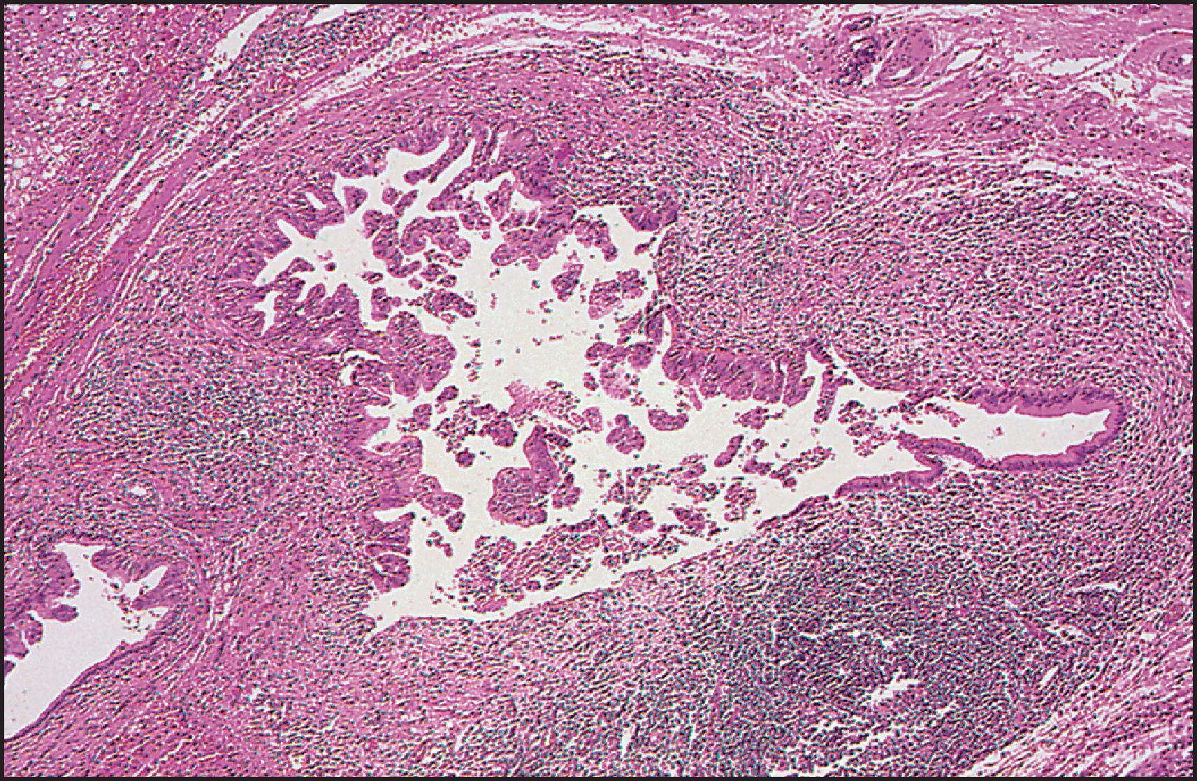 Figure 3.33, Caroli disease. The thickened bile duct wall reveals marked chronic inflammation. The lining epithelium is hyperplastic, except for a small segment of the duct (right). There is an area of ulceration (bottom). (H&E stain.)