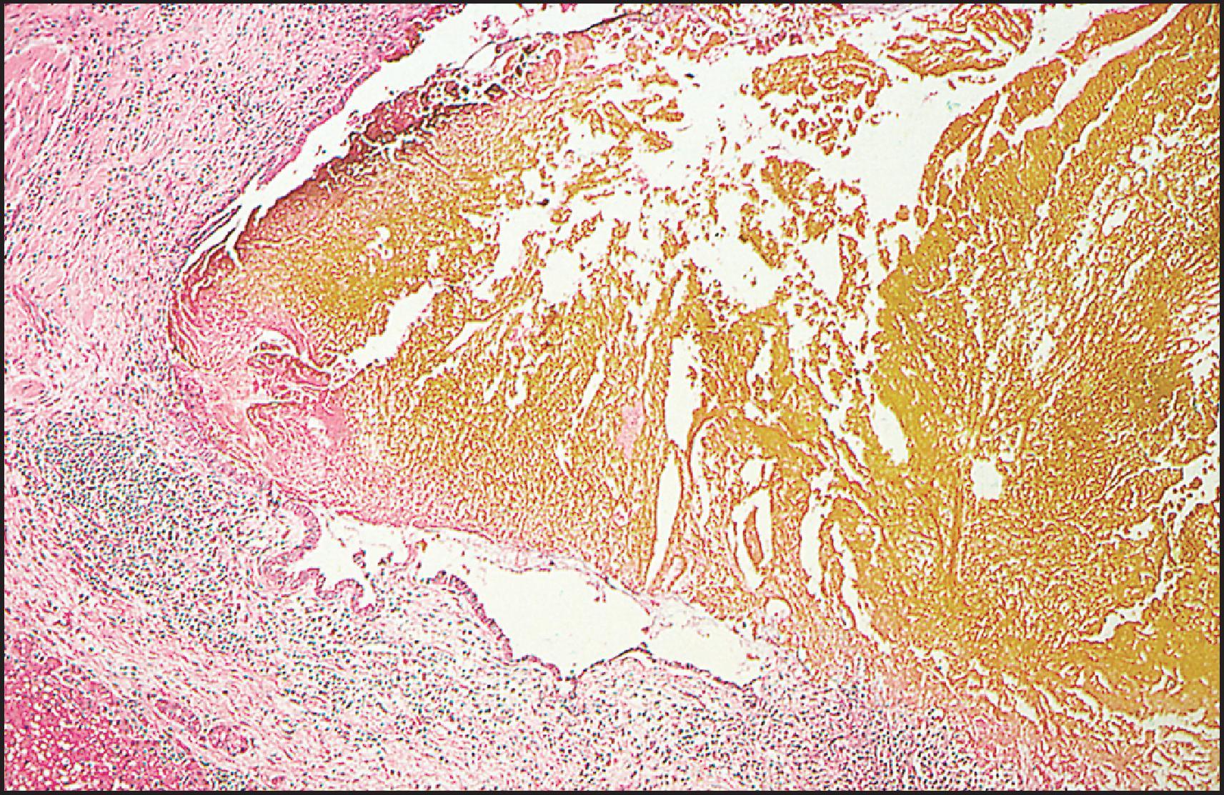 Figure 3.34, Caroli disease. Markedly dilated duct contains golden-yellow inspissated bile. It shows marked inflammation, as well as ulceration (bottom). (H&E stain.)