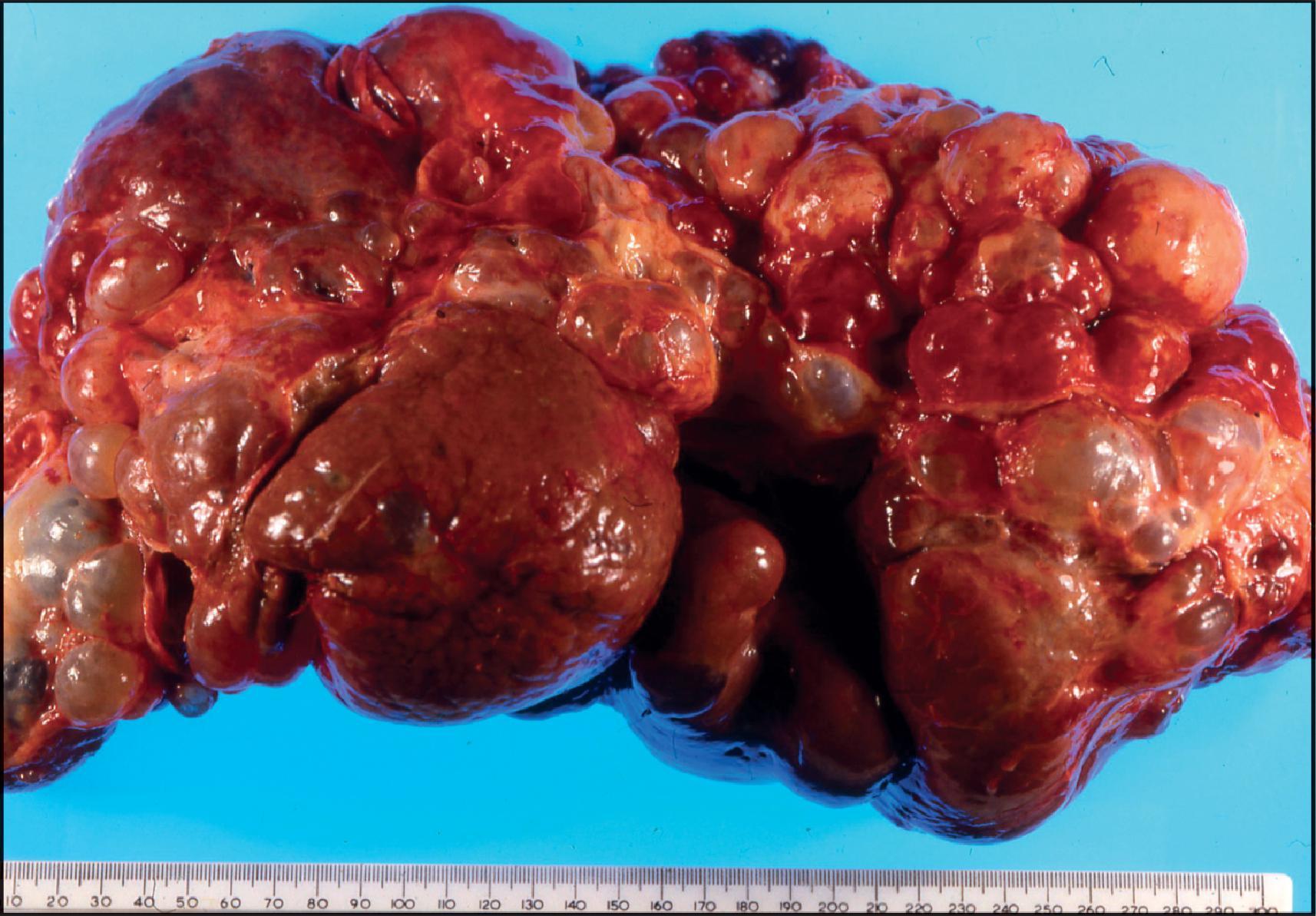 Figure 3.35, Autosomal dominant polycystic kidney disease. Numerous cysts of varied size are studded throughout the liver. They contained clear fluid.