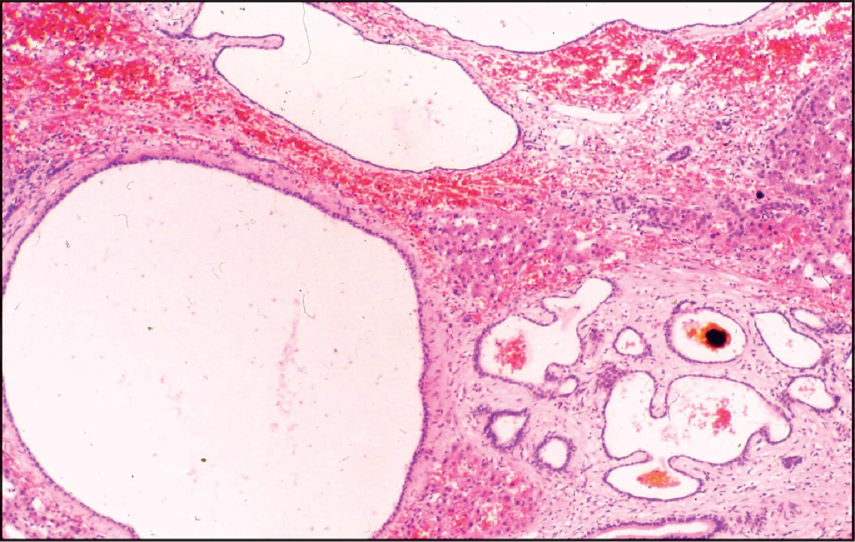 Figure 3.36, Autosomal dominant polycystic kidney disease. Section of liver shows multiple cysts of varied size that are lined by a flattened epithelium adjacent to a von Meyenburg complex. (H&E stain.)