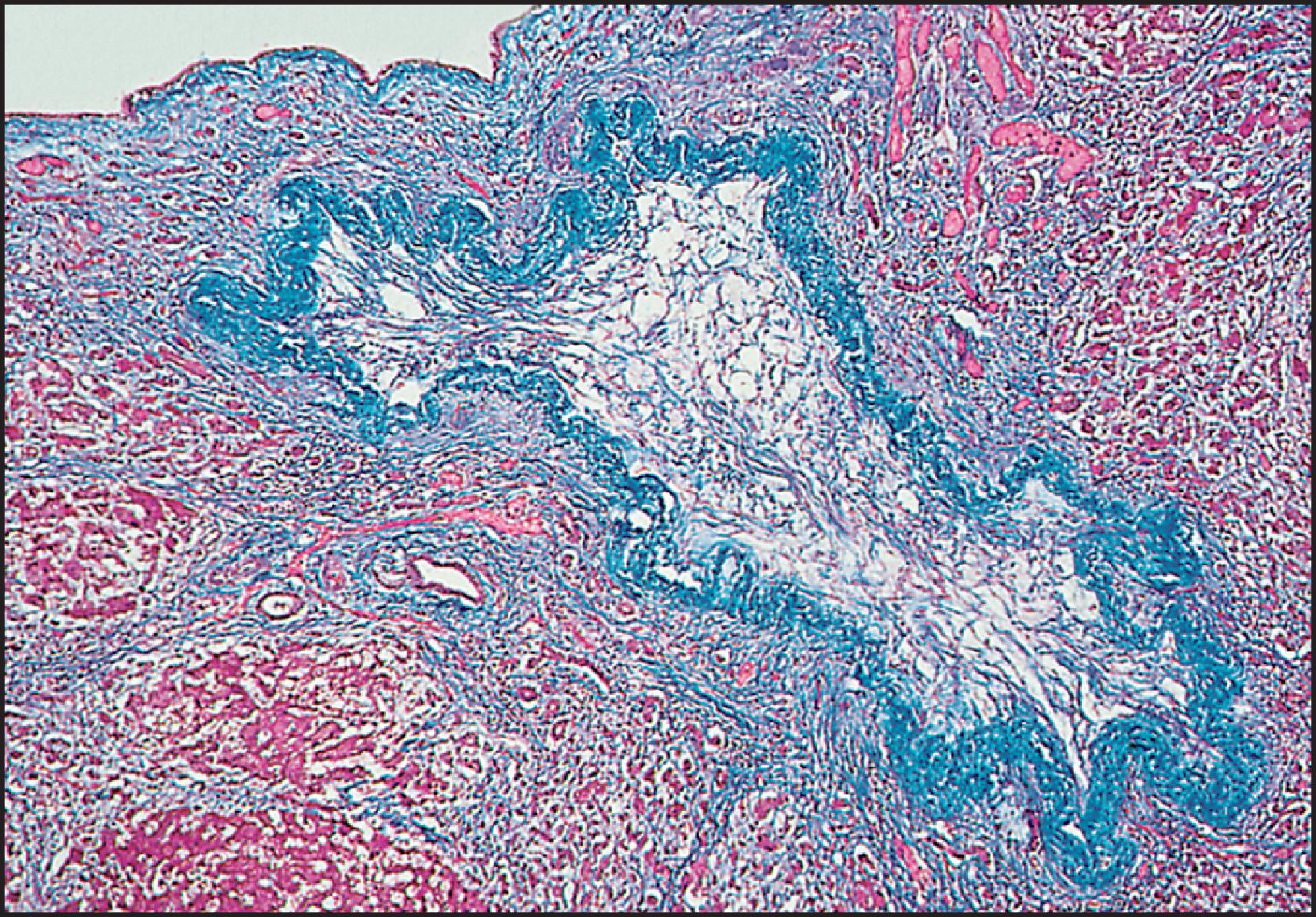 Figure 3.37, Autosomal dominant polycystic kidney disease. Collapsed cyst has a corrugated wall, and the lumen is filled in with a loose connective tissue. (Masson trichrome stain.)