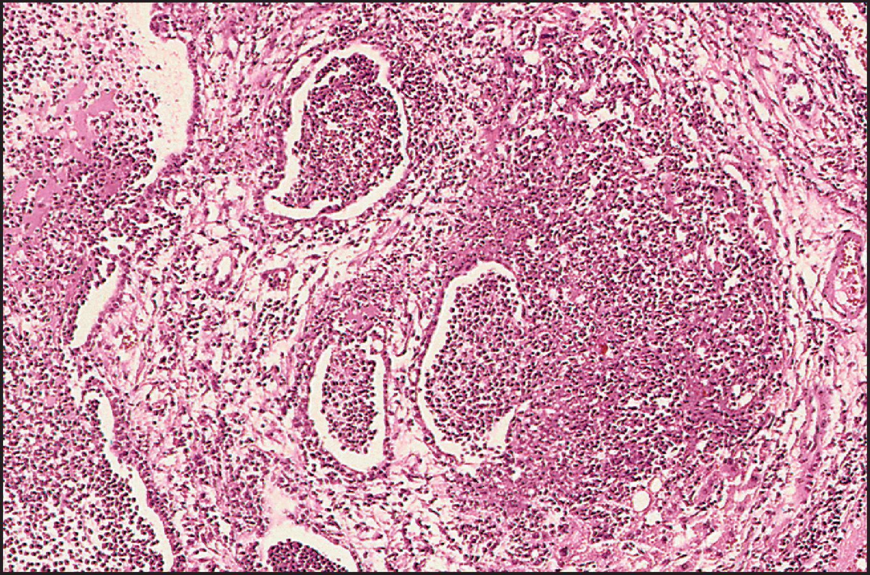 Figure 3.38, Autosomal dominant polycystic kidney disease. Infected cysts are filled with pus. The cyst to the right has ruptured with the formation of a small cholangitic abscess. (H&E stain.)