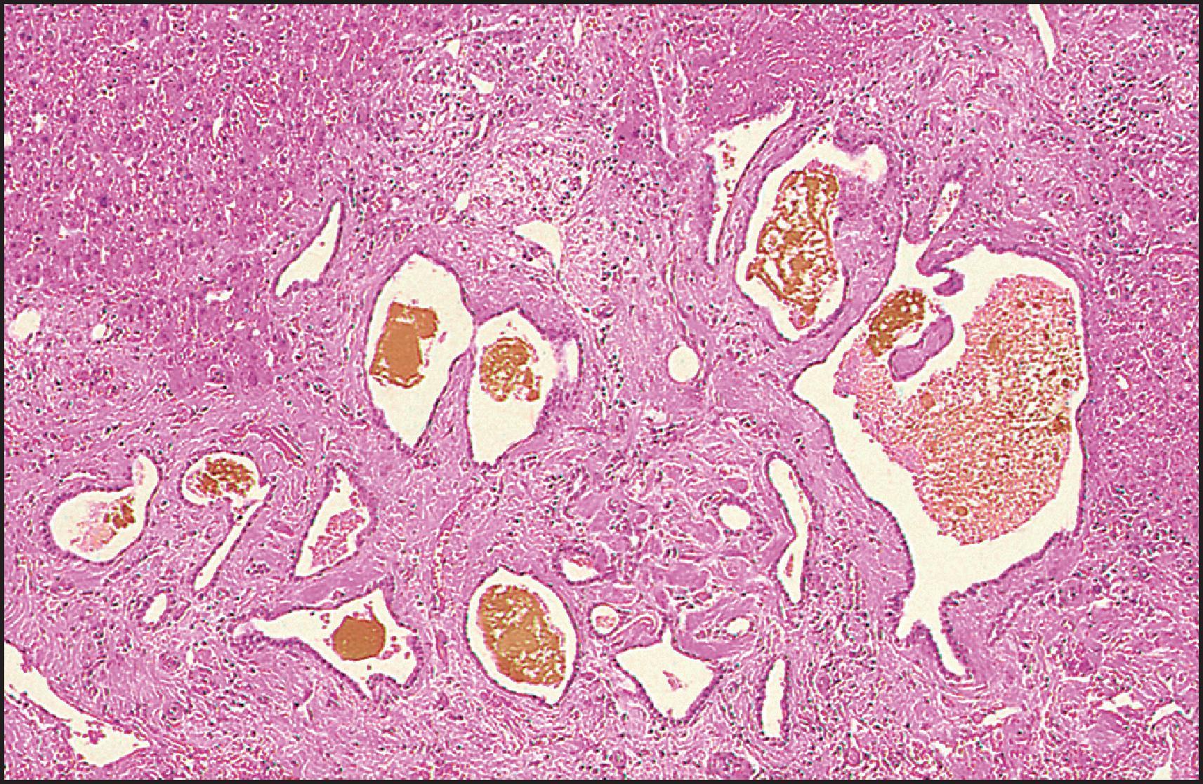 Figure 3.40, Von Meyenburg complex. The ducts are variably dilated and contain altered bile. (H&E stain.)