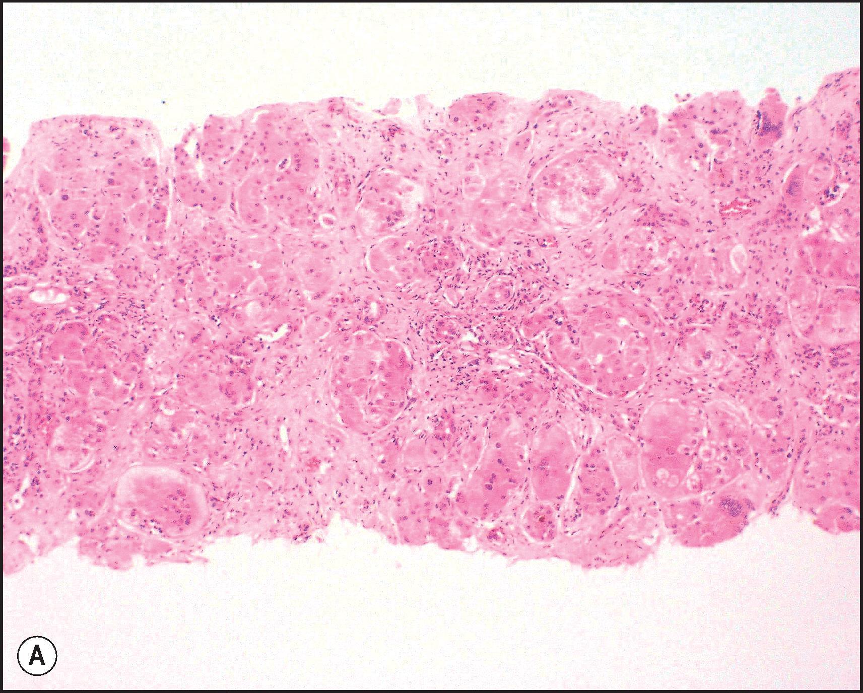 Figure 3.4, Severe neonatal hepatitis of undetermined cause. Extensive bridging parenchymal loss with concomitant reticulin collapse divides the parenchyma into minute nodules with prominent giant cell transformation. (A, H&E stain; B, Gordon–Sweet reticulin.)