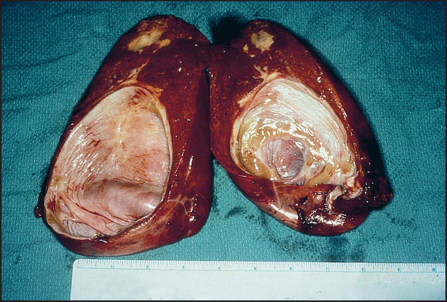 Figure 3.41, Solitary bile duct cyst. The sectioned cyst has a smooth lining.