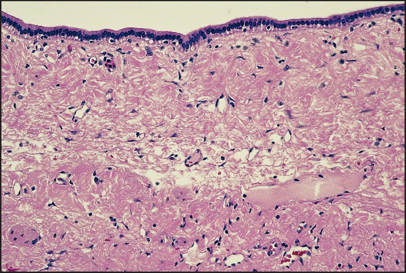 Figure 3.42, Solitary bile duct cyst. The cyst is lined by a single layer of columnar cells. (H&E stain.)