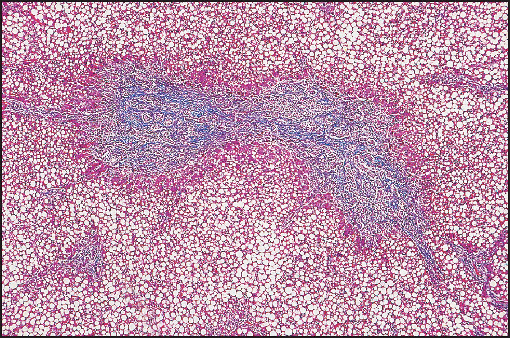 Figure 3.43, Cystic fibrosis. Periportal bridging fibrosis and ductular reaction. Note marked steatosis. (Masson trichrome stain.)