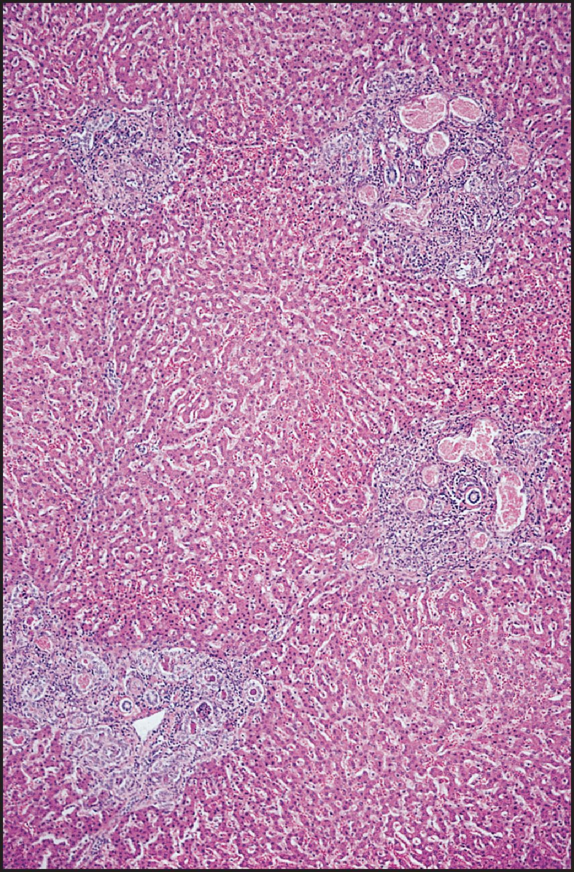 Figure 3.44, Cystic fibrosis. Expanded and moderately inflamed portal areas contain dilated bile ductules that contain greatly dilated ductules. Ductular lumens are filled with pink, inspissated secretion. (H&E stain.)