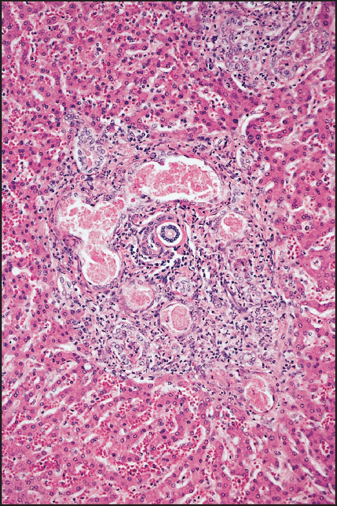 Figure 3.45, Cystic fibrosis. Dilated ductules (cholangioles) contain pink, amorphous secretion. Note the absence of lining cells. (H&E stain.)