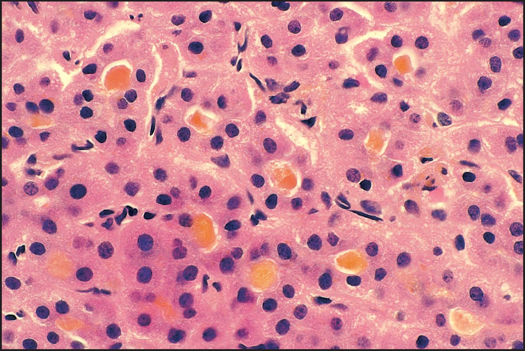 Figure 3.46, Familial intrahepatic cholestasis type 1 deficiency. Prominent canalicular cholestasis with pseudoglandular formation. (H&E stain.)