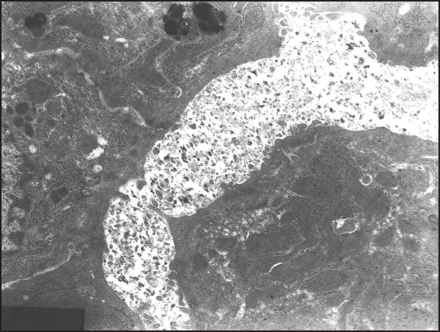 Figure 3.47, Familial intrahepatic cholestasis type 1 deficiency. Dilated canaliculus with loss of microvilli is filled with characteristically loose, coarsely granular bile.