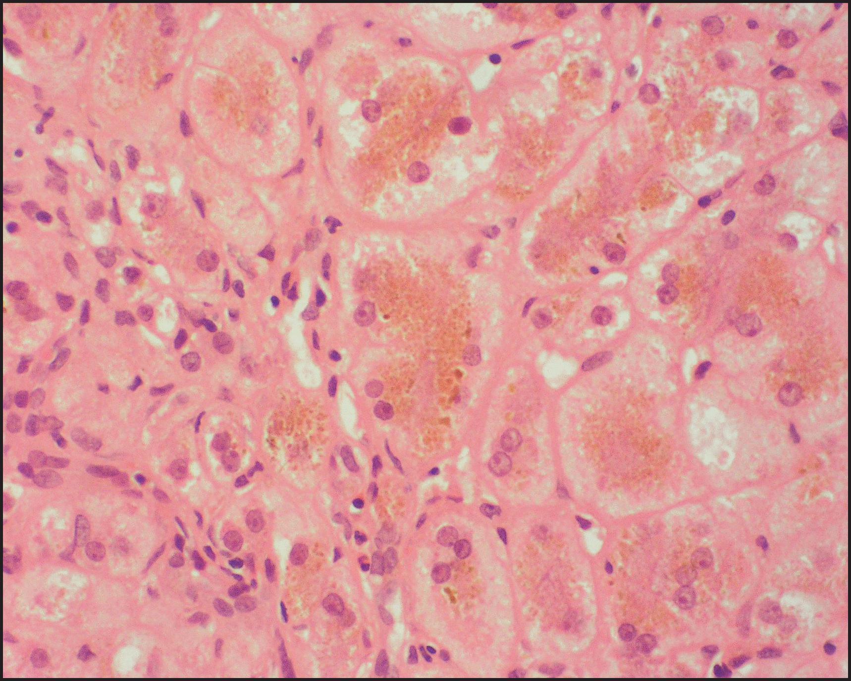 Figure 3.48, Bile salt export pump deficiency. Multinucleated giant hepatocytes are variably pale or heavily loaded with bile pigment. (H&E stain.)