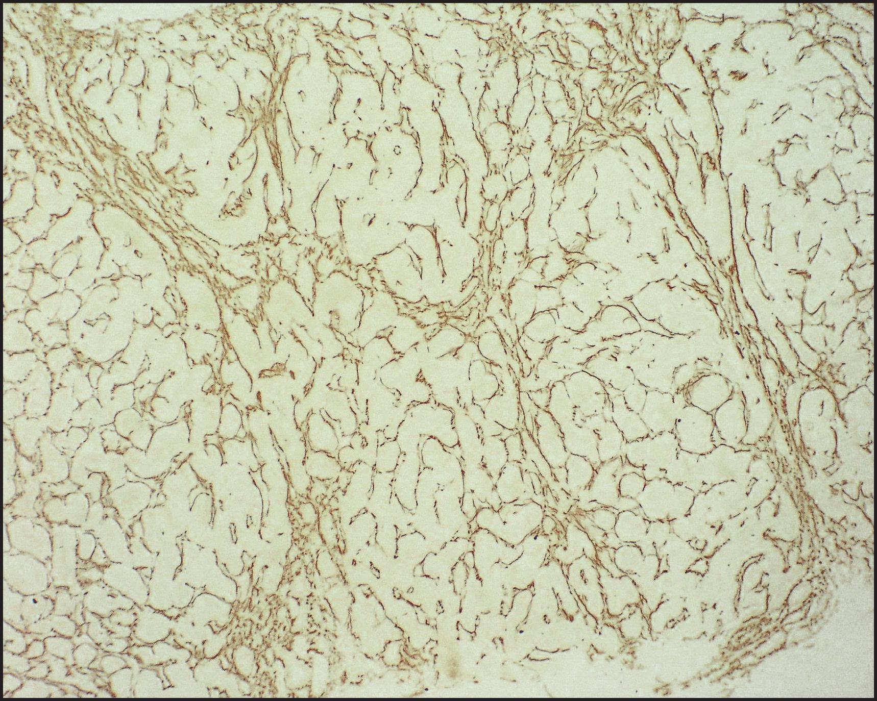 Figure 3.49, Bile salt export pump deficiency. The same case as illustrated in Fig. 3.48 showing early portoportal and portocentral bridging fibrosis. (Reticulin stain.)