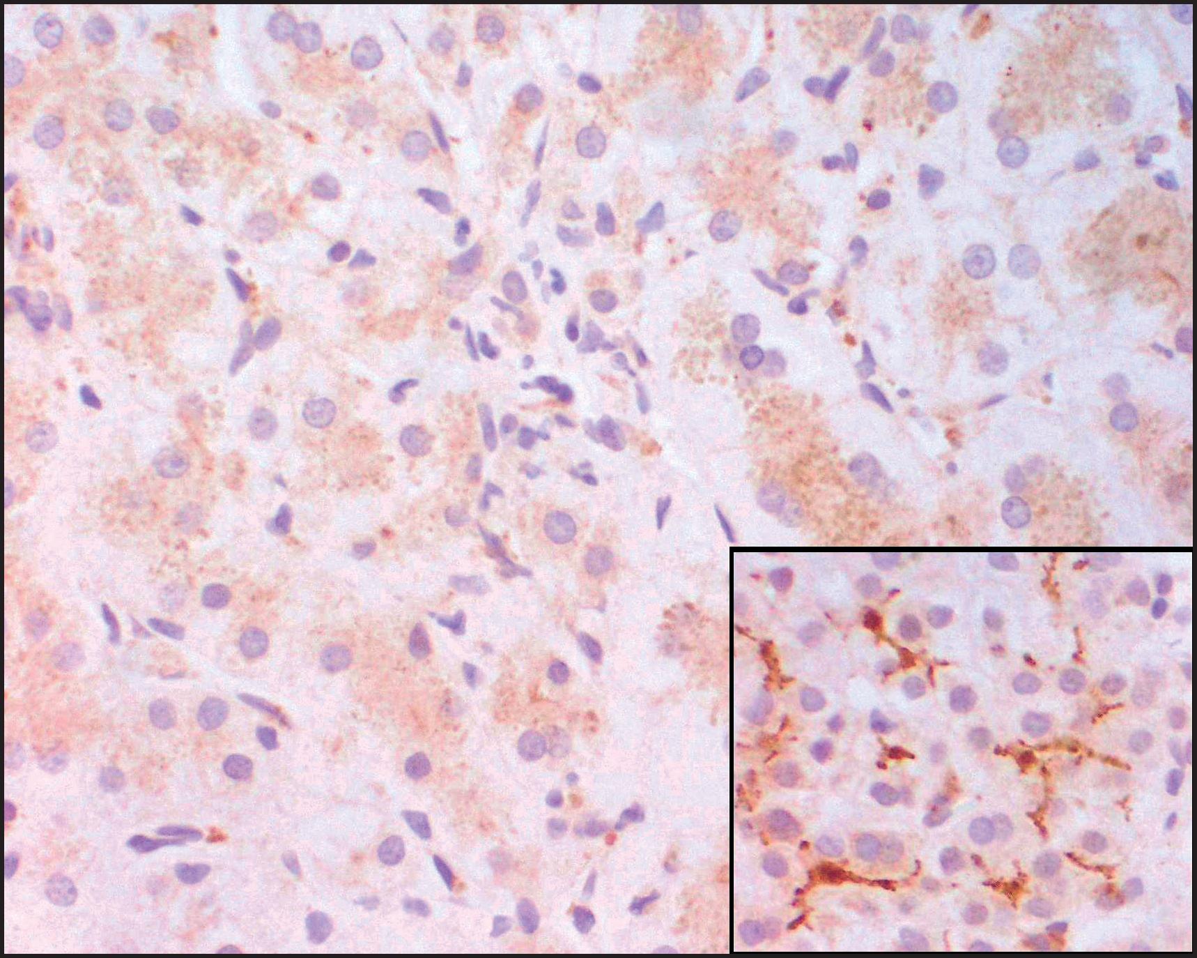 Figure 3.50, Bile salt export pump (BSEP) deficiency. The same case as shown in Figs 3.48 and 3.49 . Immunohistochemistry for BSEP shows totally absent marking at canalicular margins, whereas the control stains adequately (inset). (Peroxidase–antiperoxidase [PAP] technique.)