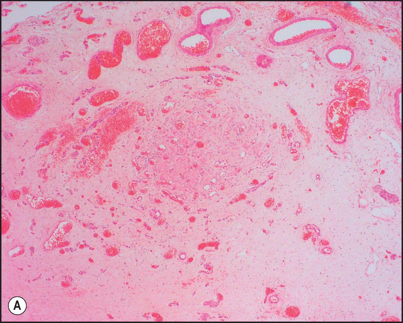 Figure 3.5, Biliary atresia. Transverse sections of biliary remnants removed at portoenterostomy. (A) Atretic common hepatic duct showing luminal occlusion by vascular fibrous tissue with very few inflammatory cells. (B) Distorted bile duct inconsistently lined by desquamated columnar epithelium and surrounded by fibroplasia with a light inflammatory cell infiltrate. (C) Cleft-like lumen devoid of epithelial lining side by side with duct structures which may represent adjacent segments of the same ducts or hyperplastic peribiliary glands. (D) Hilar region close to the surgical resection line showing numerous ducts or glandular structures set in a loose, mildly inflamed fibrous tissue. (H&E stain.)