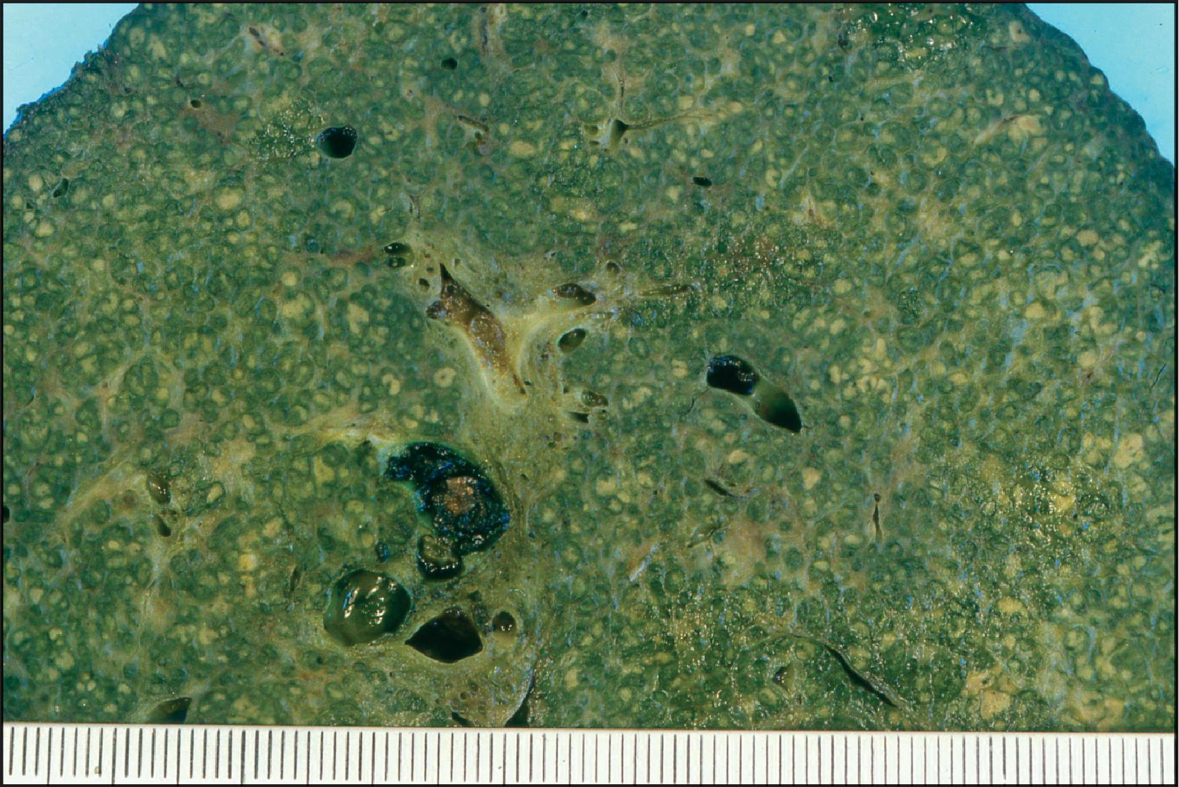 Figure 3.52, Multidrug-resistance protein 3 deficiency. Cirrhotic liver removed at transplantation shows a green discoloration and inspissated bile within dilated intrahepatic bile ducts.