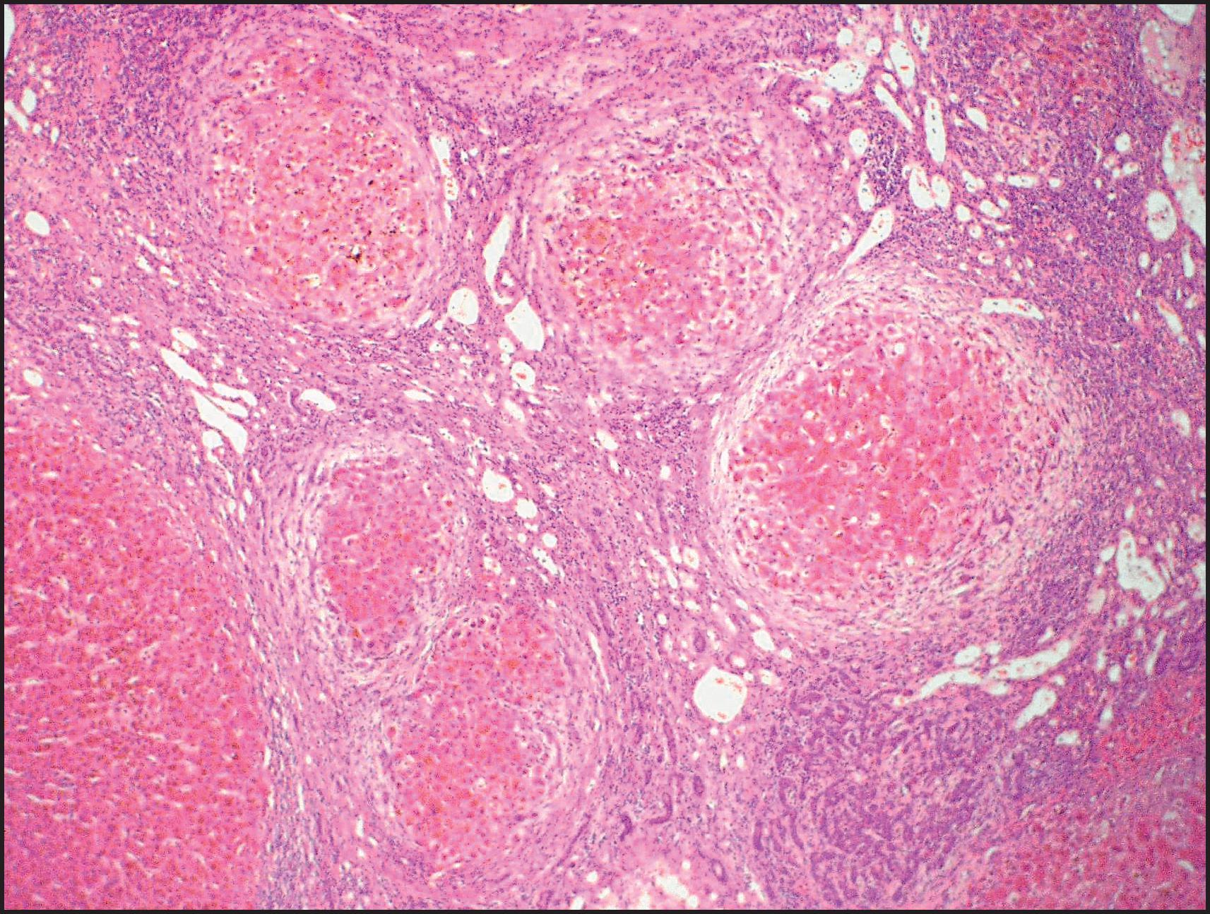 Figure 3.53, Multidrug-resistance protein 3 deficiency. The same case as illustrated in Fig. 3.52 . A micronodular pattern with perinodular halo is in keeping with an advanced biliary cirrhosis. (H&E stain.)