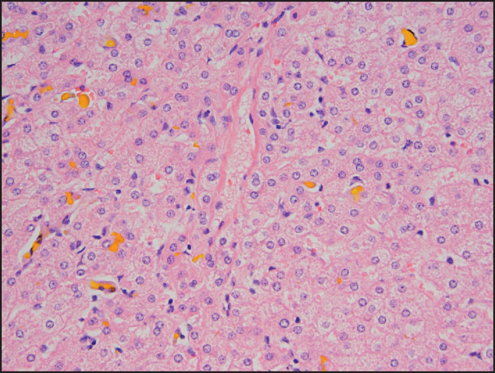 Figure 3.55, Crigler–Najjar syndrome type I. Liver removed at transplantation is normal except for bile pigment seen in some canaliculi and in Kupffer cells.