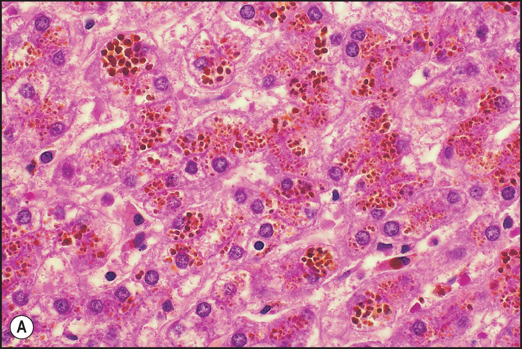 Figure 3.56, Dubin–Johnson syndrome. Liver cells contain an abundance of a brown, coarsely granular pigment. (A, H&E stain; B, Fontana stain.) (C) Immunostain for canalicular multispecific organic anion transporter showing no specific staining. Only the coarsely granular pigment is still seen. Normal control shows the expected pattern of staining (inset). (PAP method.)