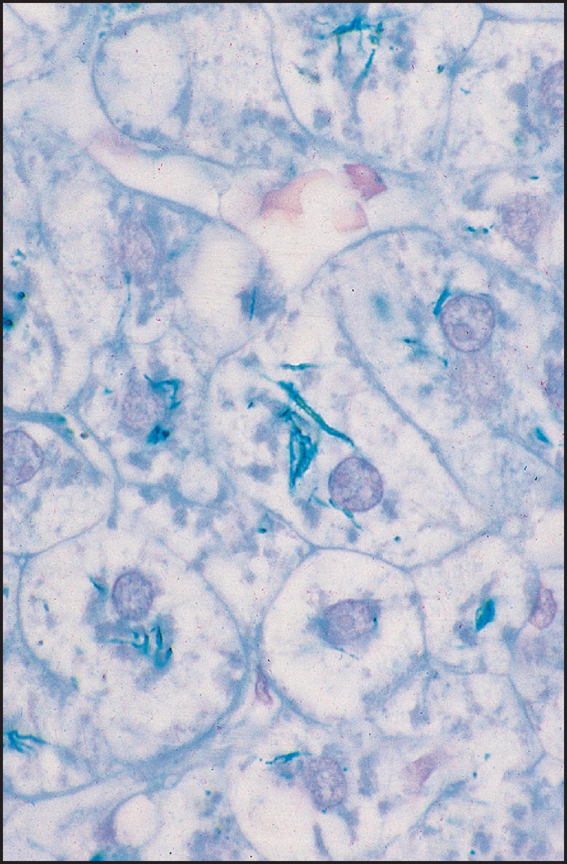 Figure 3.57, Porphyria cutanea tarda. Needle-shaped crystals of varied length are present in the cytoplasm of liver cells. (Ferric ferricyanide stain.)