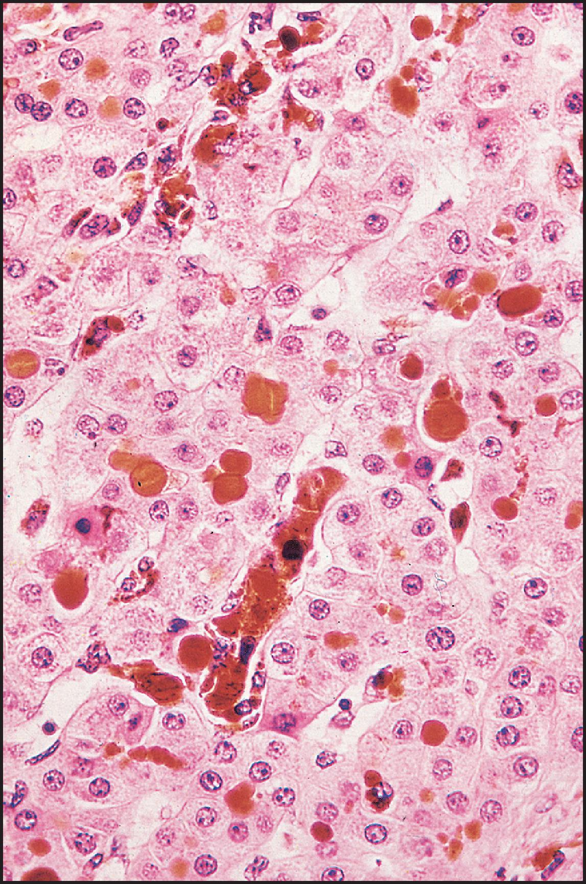 Figure 3.58, Erythropoietic protoporphyria. Brown deposits are present in canaliculi, hepatocytes and Kupffer cells. (H&E stain.)