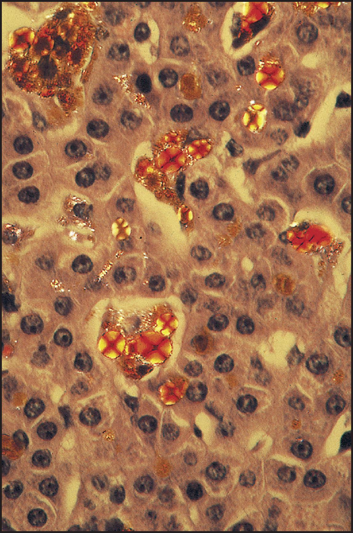 Figure 3.59, Protoporphyrin deposits have a red to yellow birefringence with a Maltese cross configuration (H&E stain.).