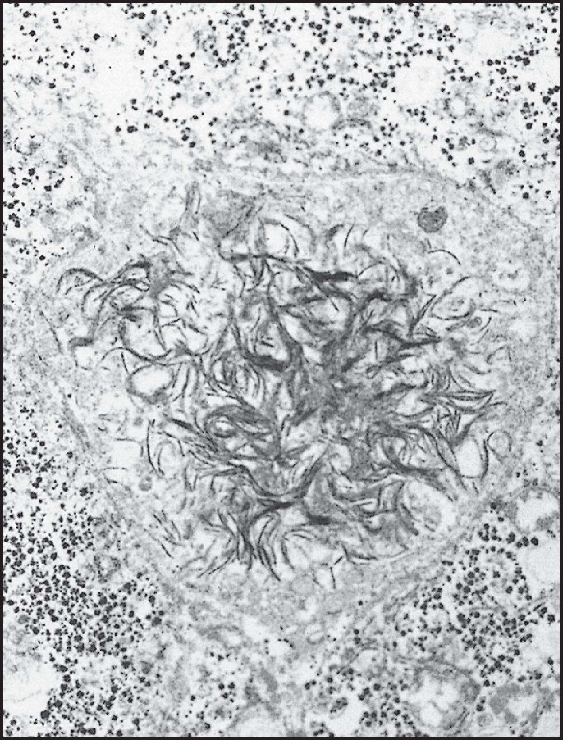 Figure 3.60, Erythropoietic protoporphyria. Electron micrograph showing a mass of radiating, hair-like pigment crystals in a dilated canaliculus. (Magnification × 1800.)