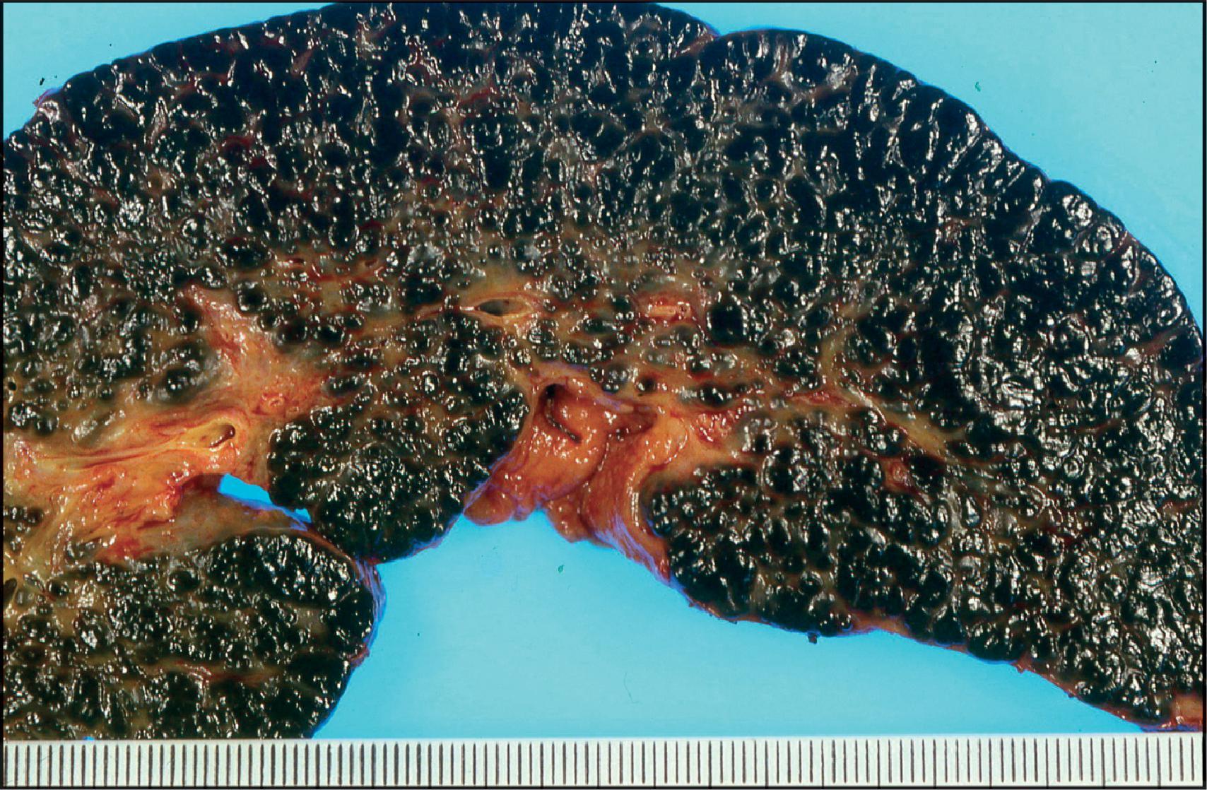 Figure 3.6, Liver removed at transplantation 6 months after a failed Kasai procedure. Cirrhosis is characterized by small and dark-green parenchymal nodules.