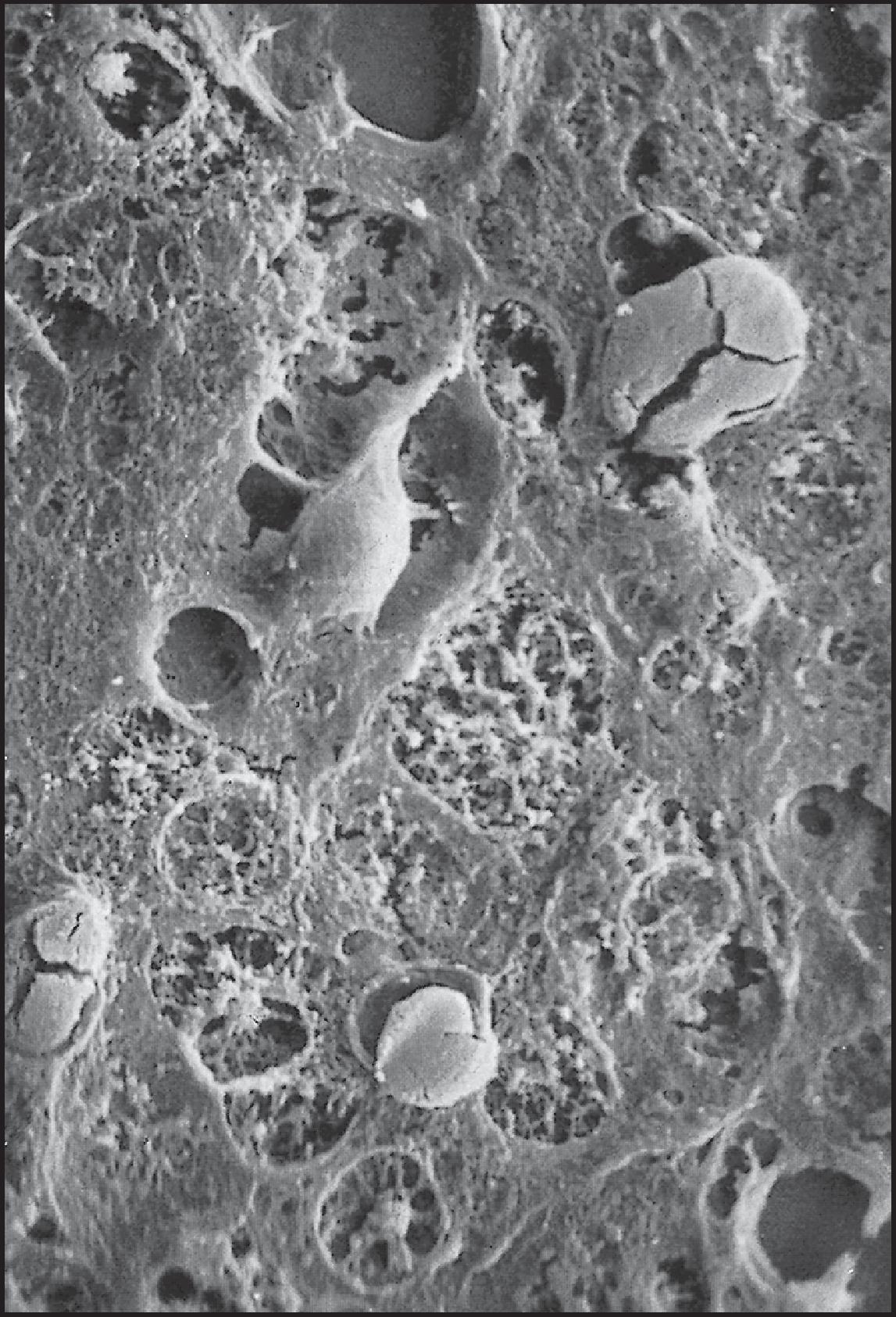 Figure 3.61, Erythropoietic protoporphyria. Rounded protoporphyrin casts in canaliculi show fracture lines. Casts are solid and have a granular structure at higher magnification. Hypertrophied Kupffer cell (upper left) probably contains phagocytosed protoporphyrin. (Scanning electron microscopy [SEM] × 1250.)