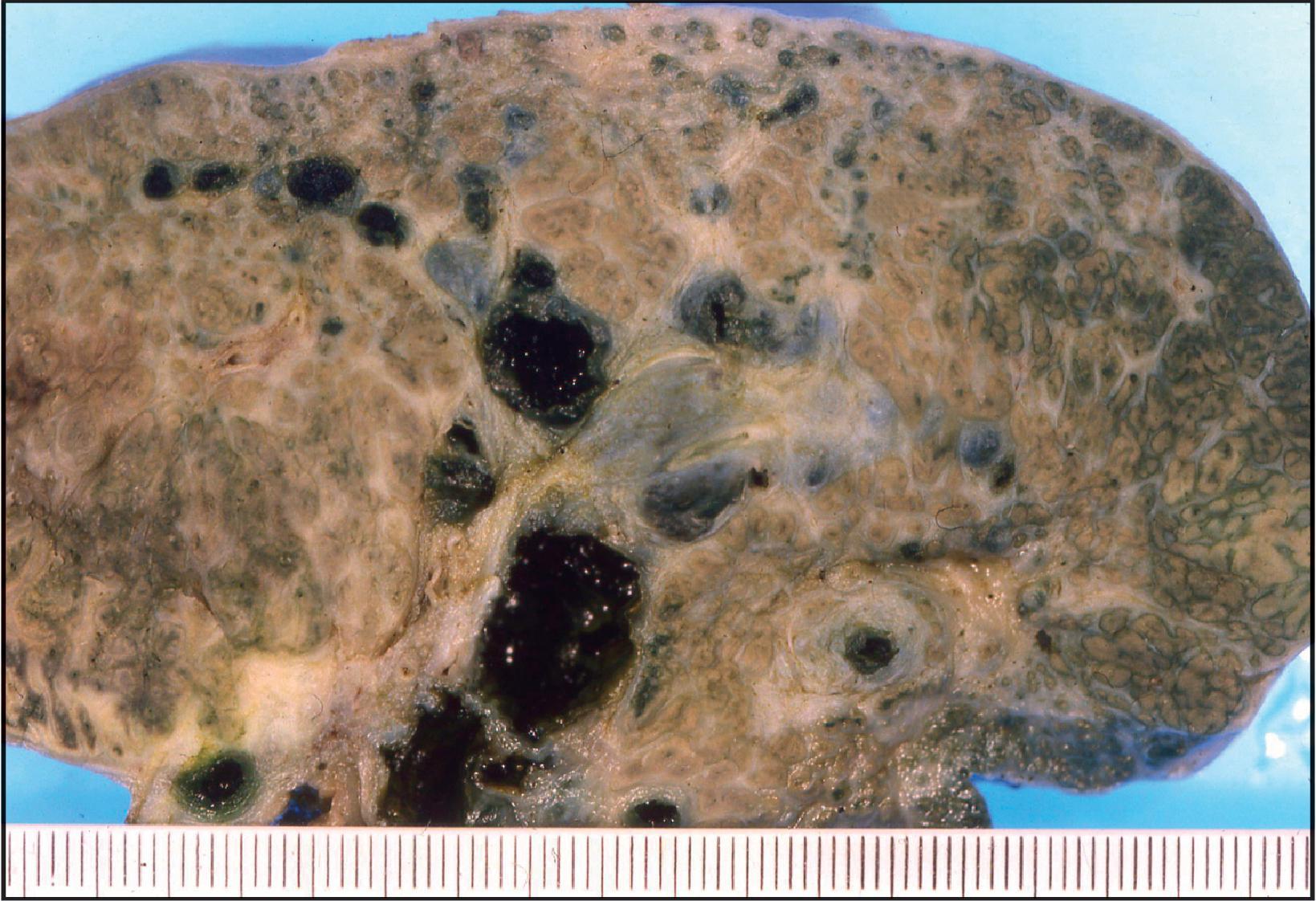 Figure 3.7, Bisected liver from patient with biliary atresia. Multiple dilated bile ducts are filled with black bilirubin casts. Some of the ducts have thick fibrous walls. The hepatic parenchyma is cirrhotic with a periseptal distribution of the cholestasis ( right of the field).