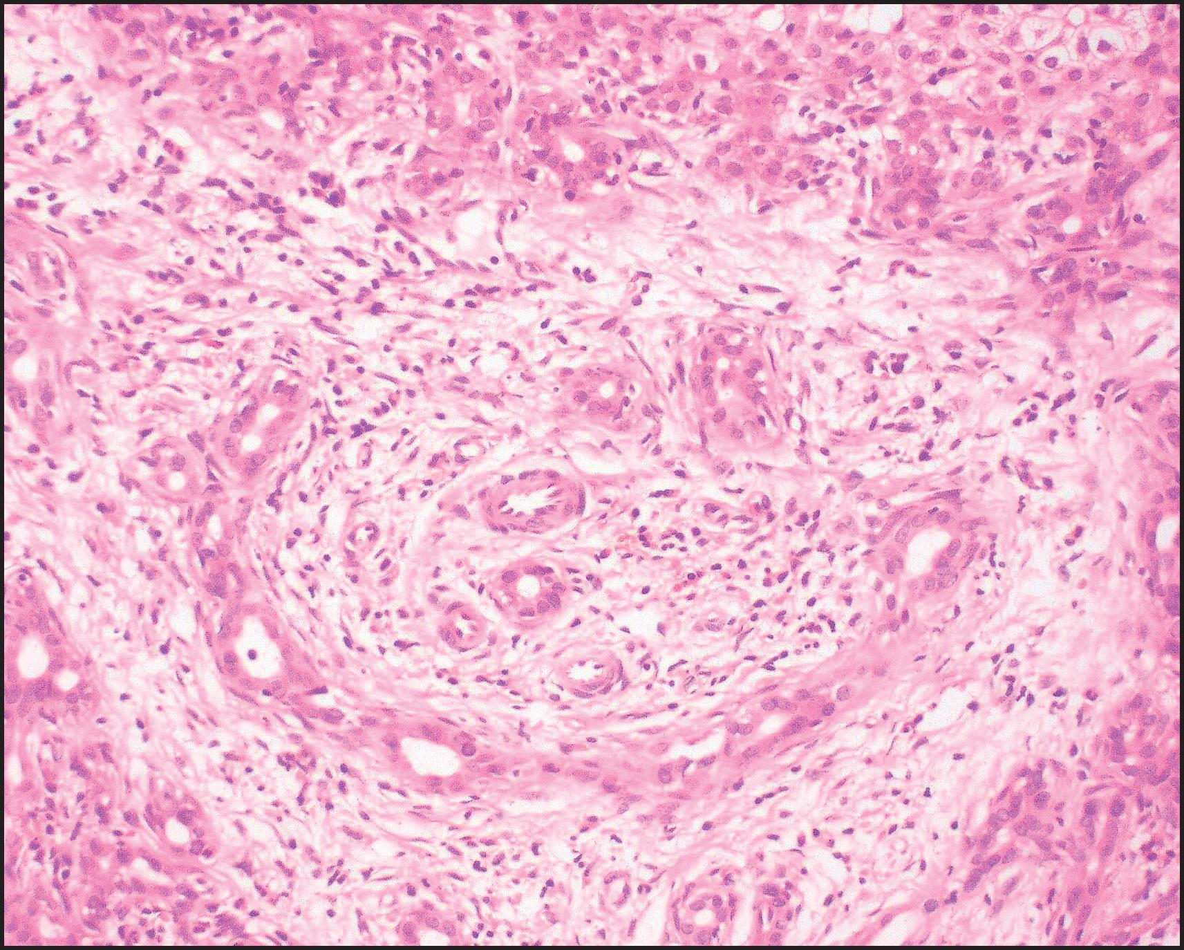 Figure 3.10, Biliary atresia. Cholangiolar reaction forming crescent-shaped profile reminiscent of the embryonal ductal plate. In our experience, this pattern may be observed irrespective of the patient having associated extrahepatic malformation. (H&E stain.)